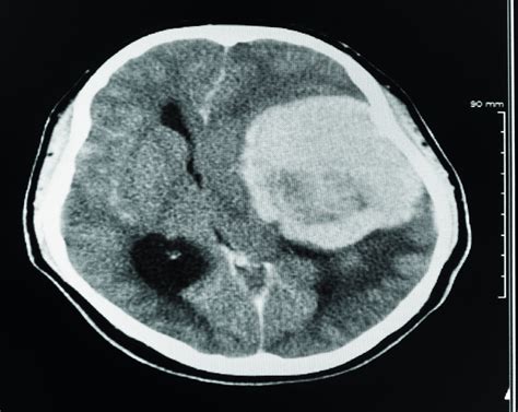 Can A Ct Scan Detect A Brain Tumor Scary Symptoms