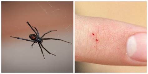 What To Do After A Black Widow Bite How To Remove A Tick Head Stuck