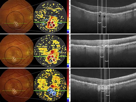 optical coherence tomography reflective drusen substructures predict progression to geographic