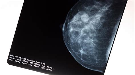 Yearly Mammograms Linked To Less Advanced Breast Cancer University Of