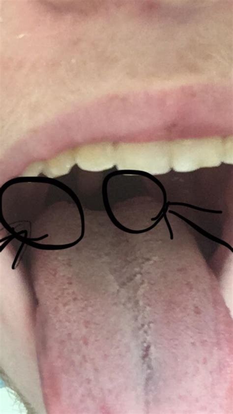 Large Bumps On Back Of Tongue Redditmd