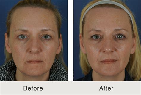 Understanding The Effects Of Skin Aging Carolina Facial Plastics