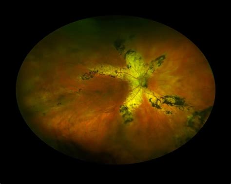 Autofluorescence Angioid Streaks American Academy Of Ophthalmology