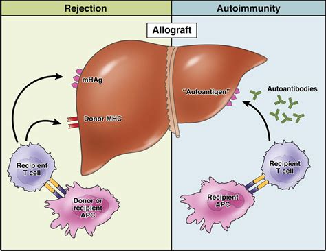 Autoimmune Hepatitis After Liver Transplantation Clinical