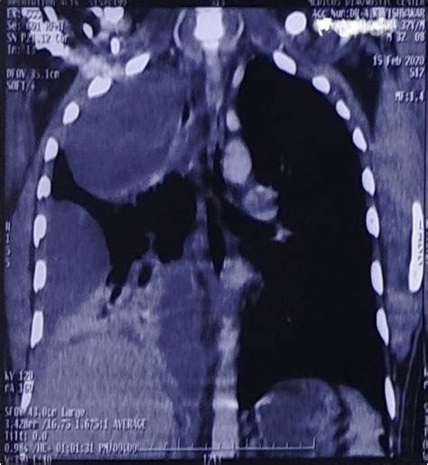 Encysted Pleural Effusion A Radiographic Mimicker Of Neoplasm