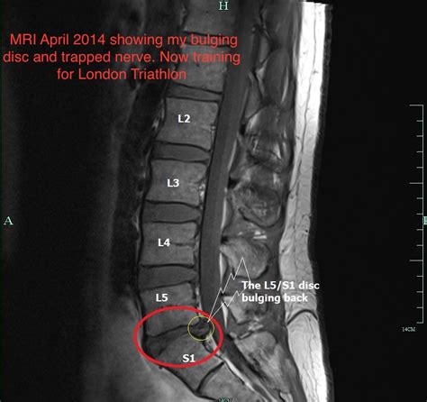 Joint pain, ankylosing spondylitis etc. Can a physio have a slipped disc? | Can a physio have a ...