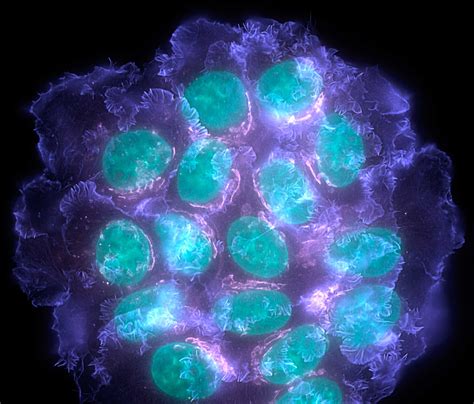 This Is What Breast Cancer Looks Like Under A Powerful Fluorescent