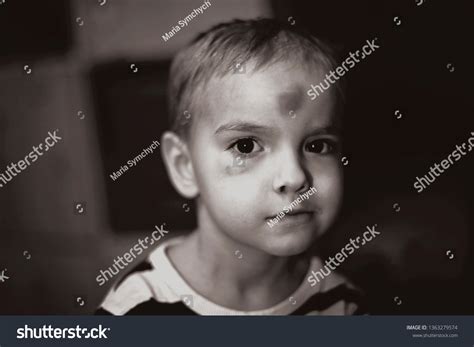 Serious Toddler Blond Boy Big Bruise Stock Photo Edit Now 1363279574