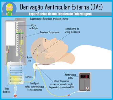Derivação Ventricular Externa DVE Enfermagem Ilustrada Enfermagem