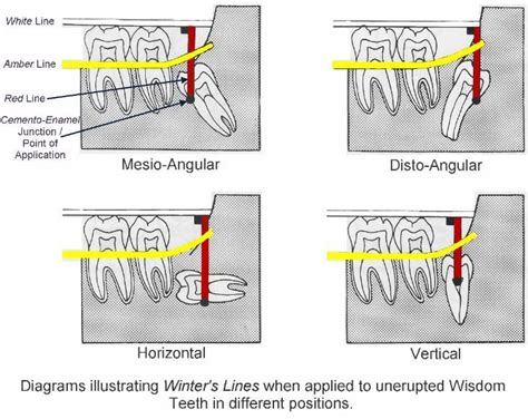 Impacted Mandibular 3rd Molar Classification Complications