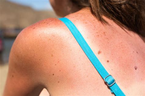 Factors That Increase Your Risk Of Skin Cancer Activebeat