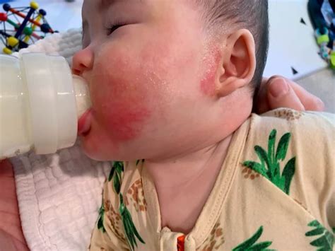 Tips For Feeding Babies With Eczema