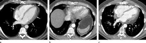 Pericardial Mesothelioma In A 42 Year Old Man With History Of