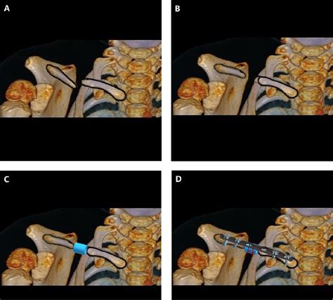 Reconstruction Of Congenital Pseudarthrosis Of The Clavicle With A