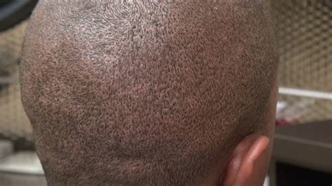 Fue Hair Transplant Donor Scar 4 Days Post Operation San Francisco Dr