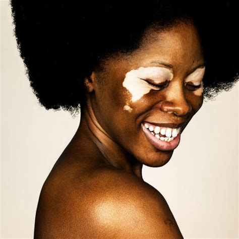 Brock Elbanks Vitiligo Series Reaches 40 Portraits