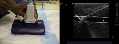 Figure 2 From Needle Tip Visualization During Ultrasound Guided