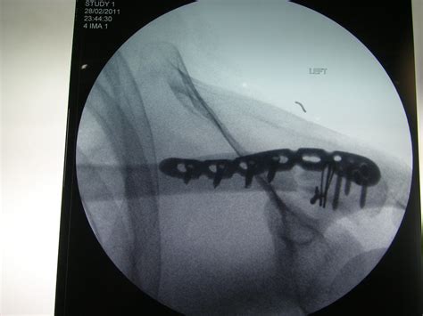If you are watching, you may be nervous about turning a truss rod too much. Surgery for Broken Bones | Singapore Sports & Orthopaedic Surgeon