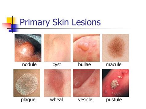 Primary Skin Lesions Dermatology Nurse Skin Respiratory Care