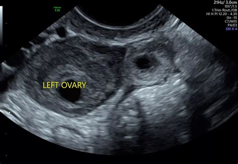 ultrasound for ectopic pregnancy sydney ultrasound care