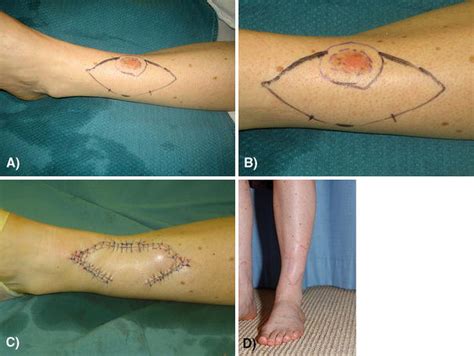 Keystone Flap Reconstruction Of Primary Melanoma Excision Defects Of