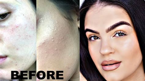 How To Get Rid Of Textured Skin Keratosis Pilaris Acne Milia Youtube