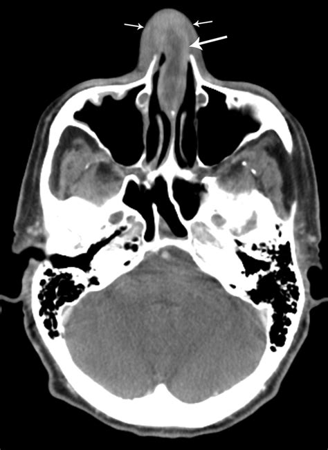 Nasal Septal Abscess In Patients With Immunosuppression American Journal Of Neuroradiology