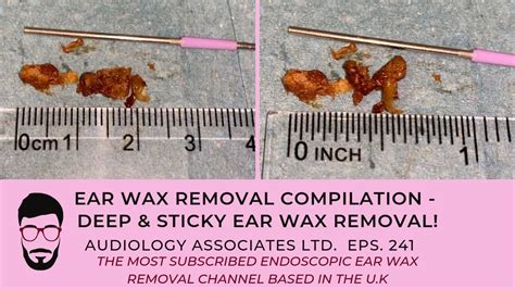 Ear Wax Removal Deep And Sticky Ear Wax Removal Ep 241 Youtube