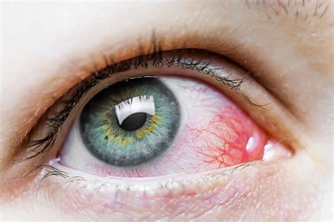 Premium Photo Close Up Of A Severe Bloodshot Red Eye Viral