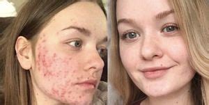 Pictures and videos about cysts and pimples. Chin Acne: What it means and how to get rid of it fast
