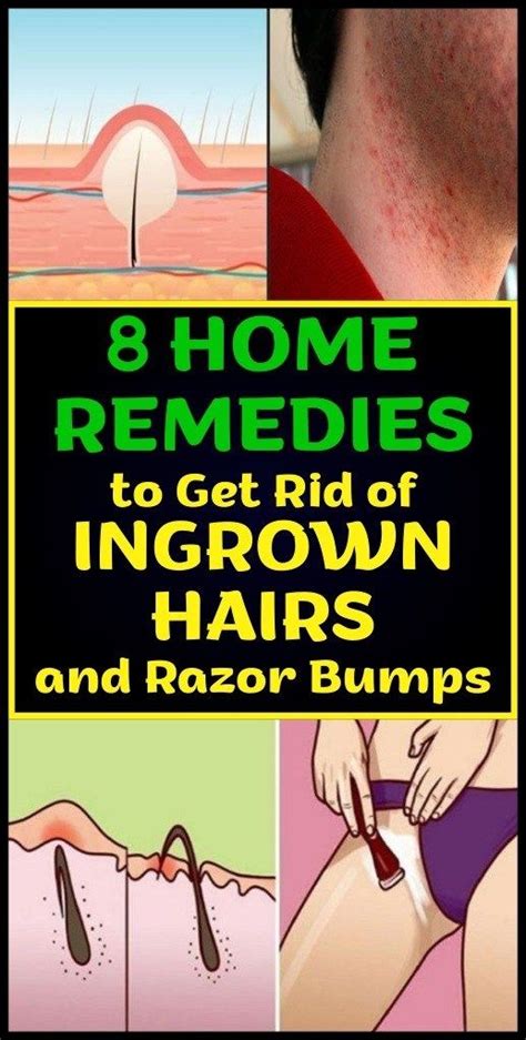 8 Home Remedies To Get Rid Of Ingrown Hairs And Razor Bumps Hussis