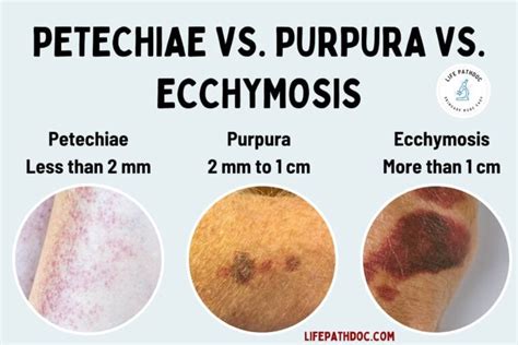 Petechiae Vs Purpura Vs Ecchymosis Causes And Treatment