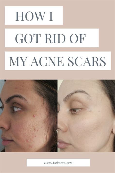 How To Get Rid Of Pitted Acne Scars