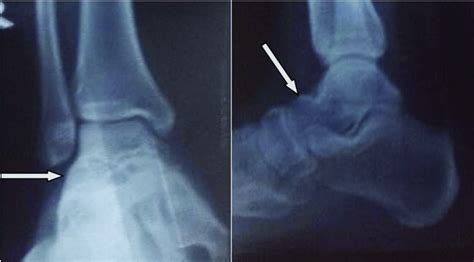 Ap And Lateral View Of Right Ankle Showing Lytic Lesion With Sclerotic