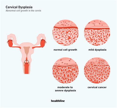 Cervical Dysplasia Causes Risk Factors And Diagnosis