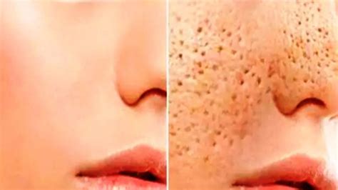 As a result, dead skin cells collect inside the pores along with dirt, sweat, sebum and bacteria. The Path We Live: How To Reduce The Pores On The Face ...