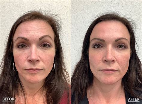 Omaha Cosmetic Surgery Revance Rha Filler Schlessinger Md Lovelyskin™