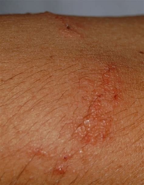 Mystery Poison Ivy Contact Dermatitis Rash From House Plants