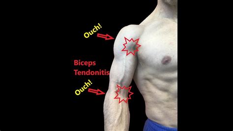 Biceps Tendonitis Stretches And Fascial Release Youtube Bicep