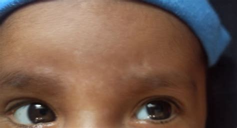 White Spots On Forehead Babycentre