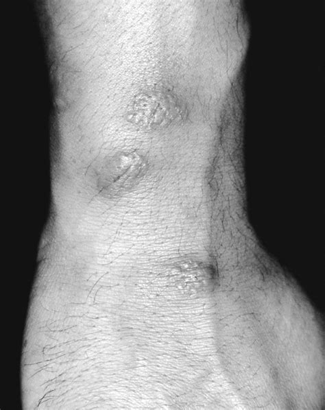A more severe injury, such as a surgical procedure, can result in persistent ulceration in a. "Neuro-Sweet Disease": Benign Recurrent Encephalitis With ...