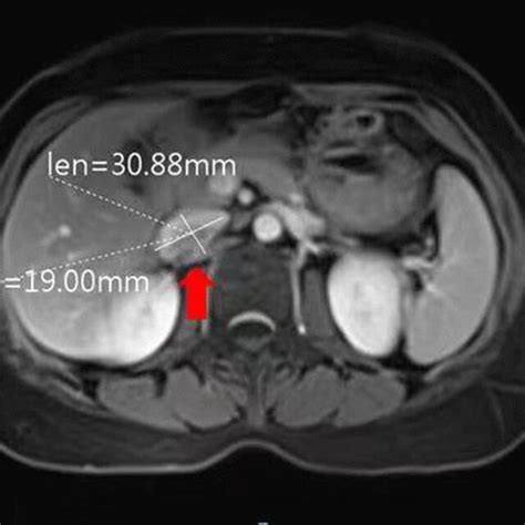 Ct Image Of Lymph Node Metastasis In The Abdominal Aorta Download