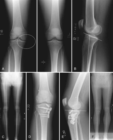Fractures Of The Patella Musculoskeletal Key