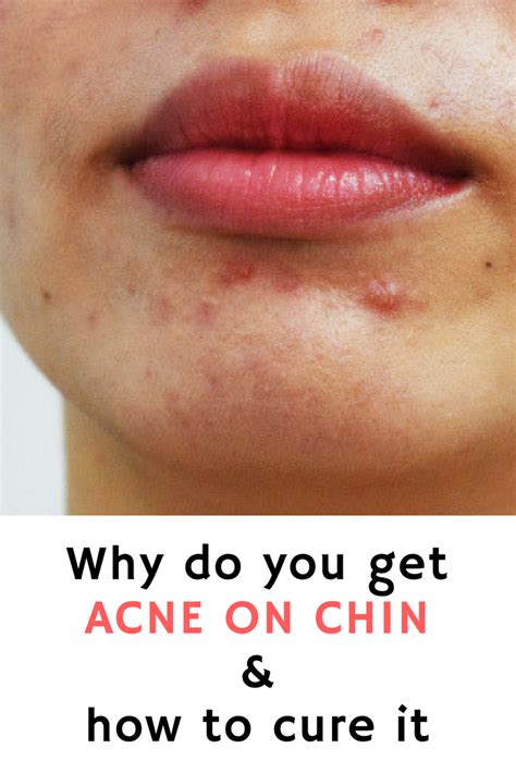How To Treat Cystic Acne On Jawline