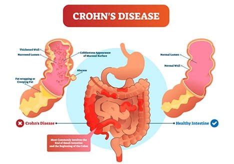 Nyc Crohn S Disease Specialist Gastroenterologist Gi Doctor