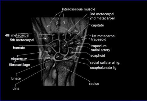Simplified radiological anatomy of the foot. MRI wrist coronal anatomy | wrist tendon and ligaments ...