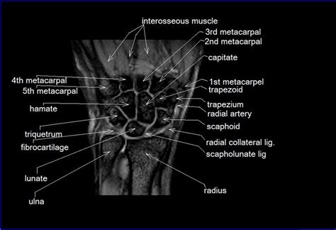 Radiologists perform ankle imaging to assess injuries of the foot and ankle anatomy. MRI wrist coronal anatomy | wrist tendon and ligaments ...