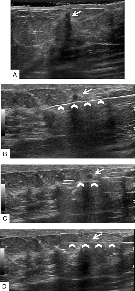 Ultrasound‐guided Breast Biopsies Bhatt 2021 Journal Of