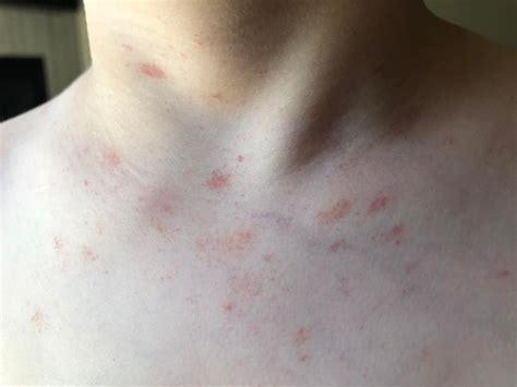 Non Itchy Rash Rdermatologyquestions