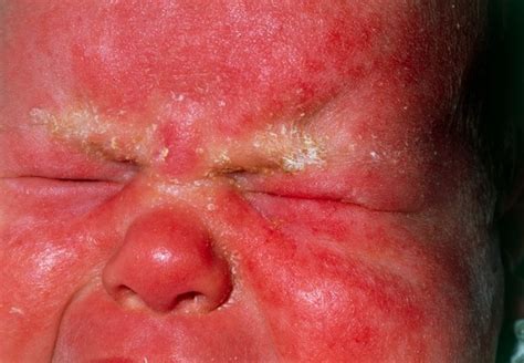 Dermatite Seborroica Crosta Lattea Nei Bambini Foto Per Riconoscerla Nostrofiglio It